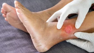 Zwei behandschuhte Hände untersuchen offene Wunde am Unterschenkel.