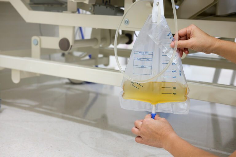 Hände öffnen Ablassventil eines Urinbeutels mit gelblicher Flüssigkeit.
